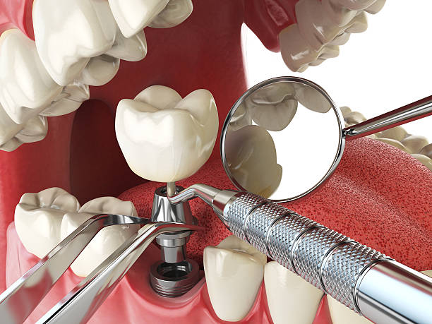 Best Emergency Root Canal Treatment in Kemp Mill, MD